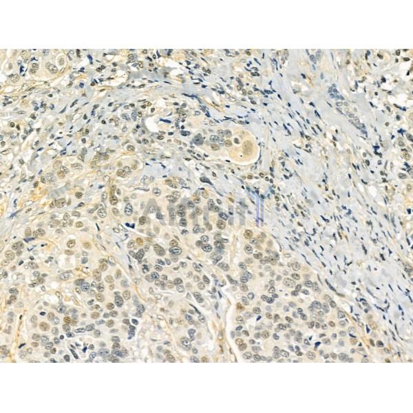 TLE3 Antibody - DF12237 at 1/100 staining Human mammary cancer by IHC-P.