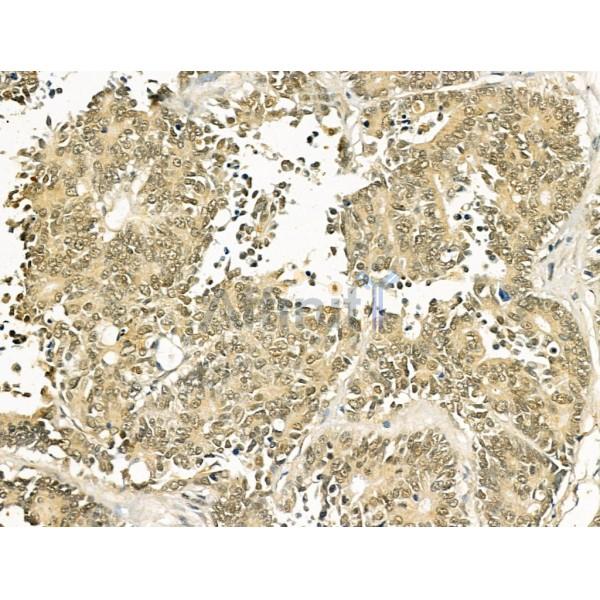 TLE3 Antibody - DF12237 at 1/100 staining Human colorectal cancer by IHC-P.