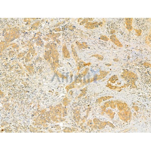 TMOD4 Antibody - DF12238 at 1/100 staining Human mammary cancer by IHC-P.