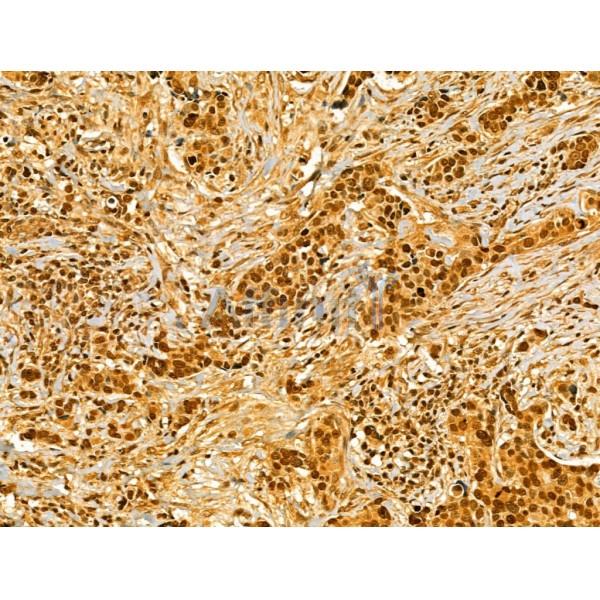 AEBP2 Antibody - DF12245 at 1/100 staining Human mammary cancer by IHC-P.