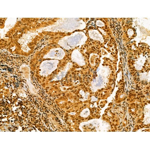 AEBP2 Antibody - DF12245 at 1/100 staining Human lung cancer by IHC-P.