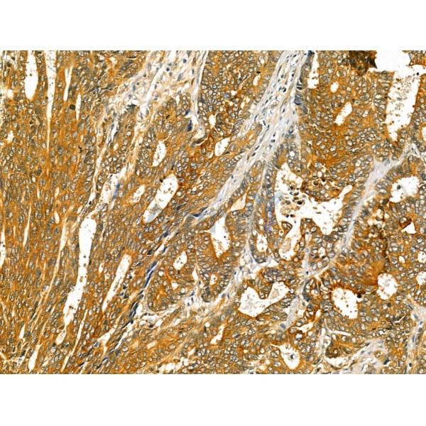 ODZ1 Antibody - DF13206 at 1/100 staining Human colorectal cancer by IHC-P.