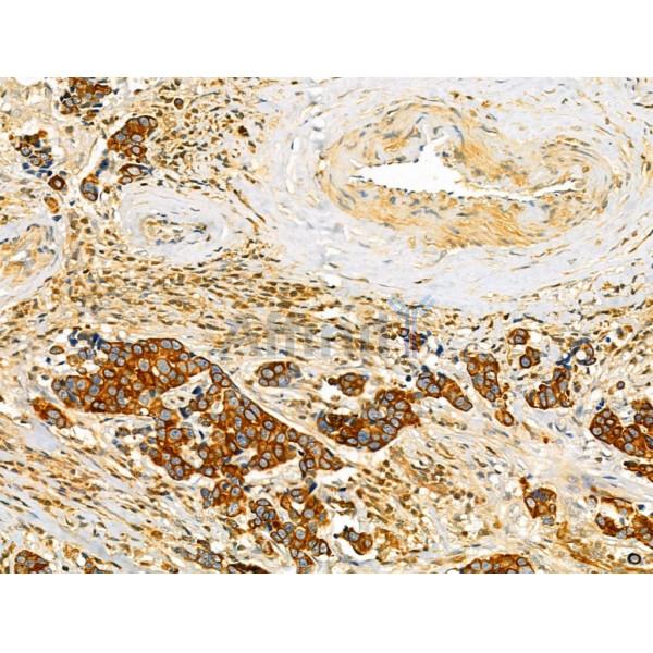 ODZ1 Antibody - DF13206 at 1/100 staining Human mammary cancer by IHC-P.