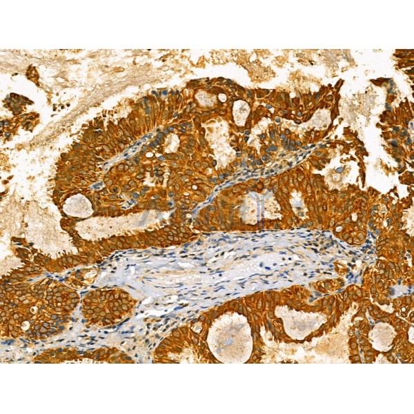 ODZ1 Antibody - DF13206 at 1/100 staining Human lung cancer by IHC-P.