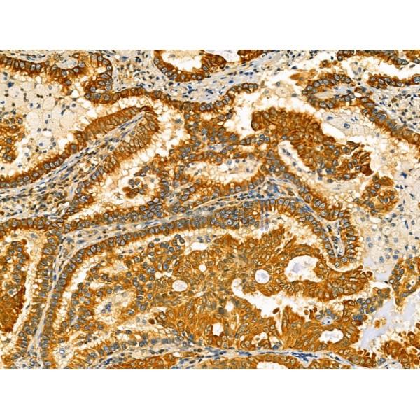 ODZ1 Antibody - DF13206 at 1/100 staining Human lung cancer by IHC-P.