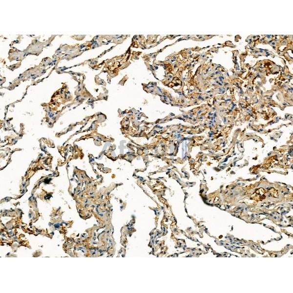 Pericentrin - Centrosome Marker Antibody - DF13210 at 1/100 staining Human lung cancer and adjacent normal tissues by IHC-P.
