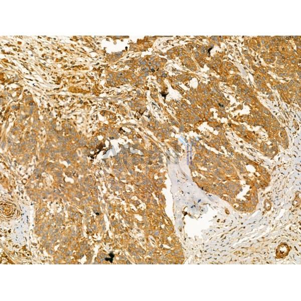 Pericentrin - Centrosome Marker Antibody - DF13210 at 1/100 staining Human ovarian cancer by IHC-P.