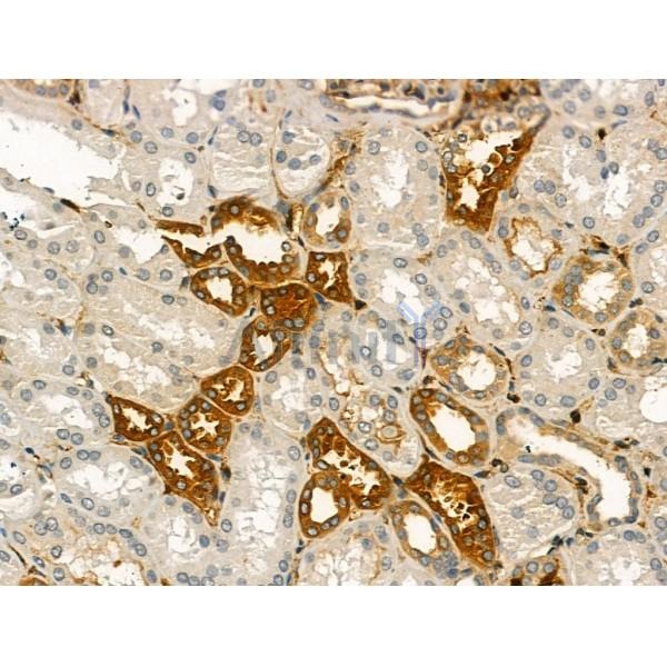 Pericentrin - Centrosome Marker Antibody - DF13210 at 1/100 staining Human kidney cancer and adjacent normal tissues by IHC-P.