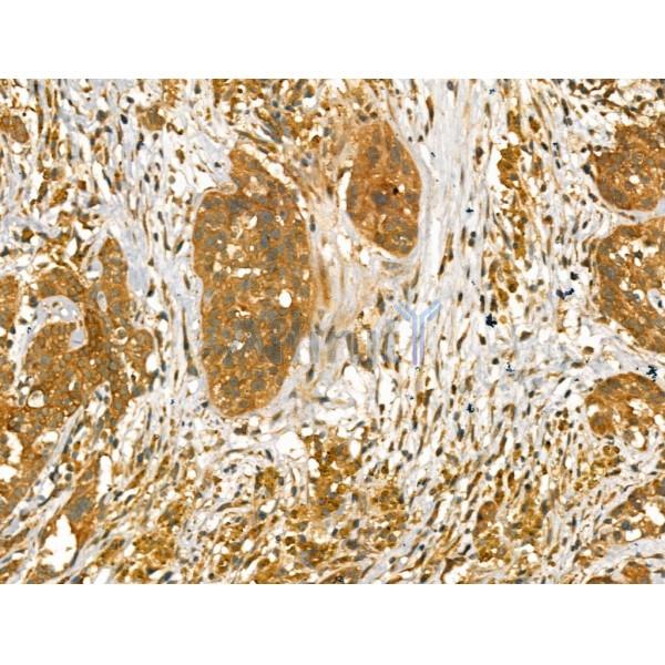 beta COP Antibody - DF13220 at 1/100 staining Human ovarian cancer by IHC-P.