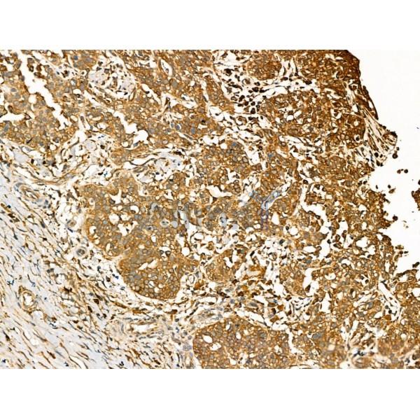 GJB6 Antibody - DF13225 at 1/100 staining Human ovarian cancer by IHC-P.