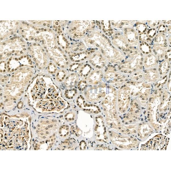 cbx7 Antibody - DF13257 at 1/100 staining Human kidney cancer and adjacent normal tissues by IHC-P.