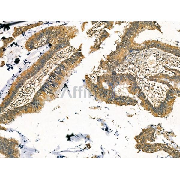 Mannosidase II Antibody - DF13260 at 1/100 staining Human colorectal cancer by IHC-P.