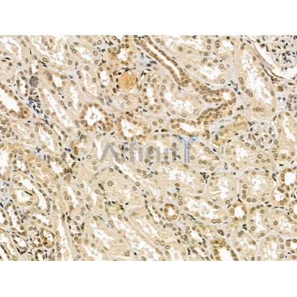 CENPB Antibody - DF13261 at 1/100 staining Human kidney cancer and adjacent normal tissues by IHC-P.