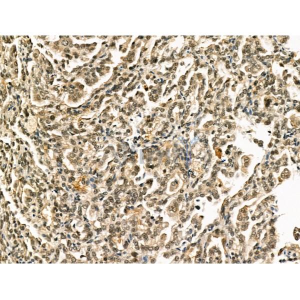 CENPB Antibody - DF13261 at 1/100 staining Human kidney cancer by IHC-P.
