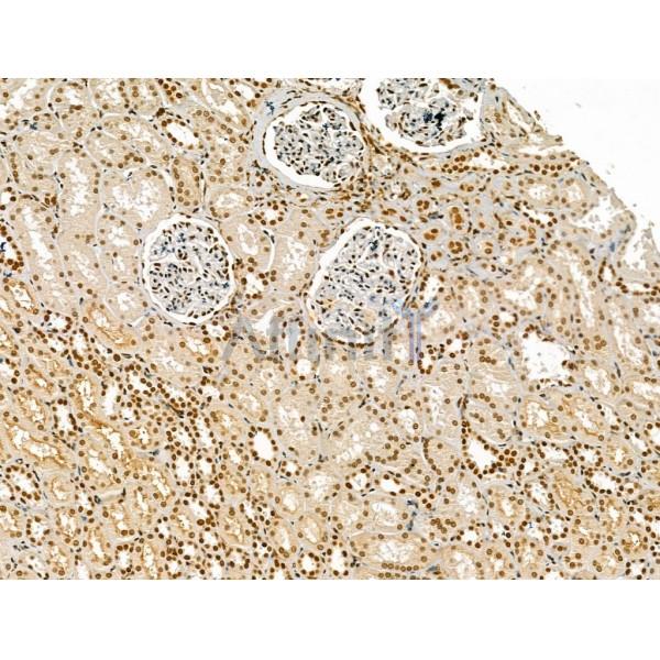 LAP2 alpha Antibody - DF13264 at 1/100 staining Human kidney cancer and adjacent normal tissues by IHC-P.