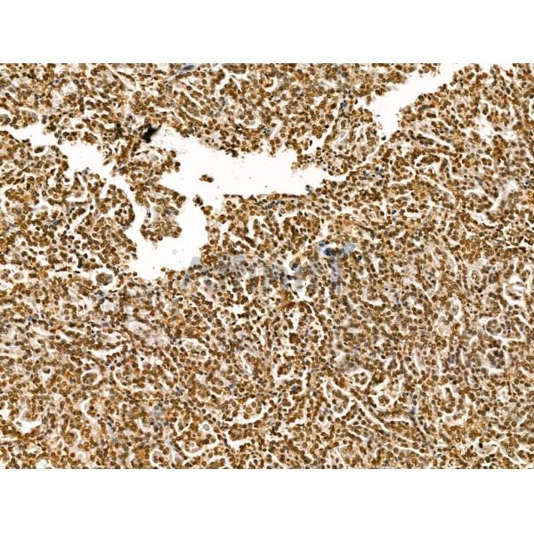 LAP2 alpha Antibody - DF13264 at 1/100 staining Human kidney cancer by IHC-P.