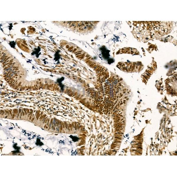 LAP2 alpha Antibody - DF13264 at 1/100 staining Human colorectal cancer by IHC-P.