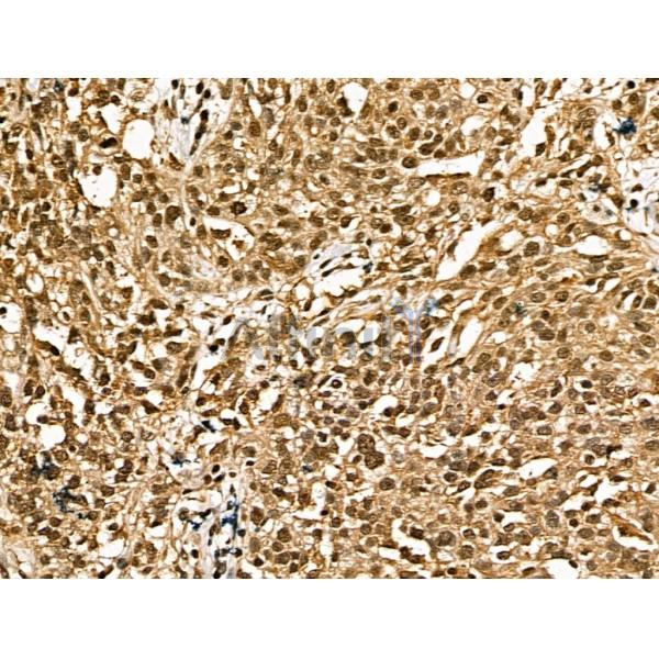 Retinoid X Receptor beta Antibody - DF13265 at 1/100 staining Human ovarian cancer by IHC-P.