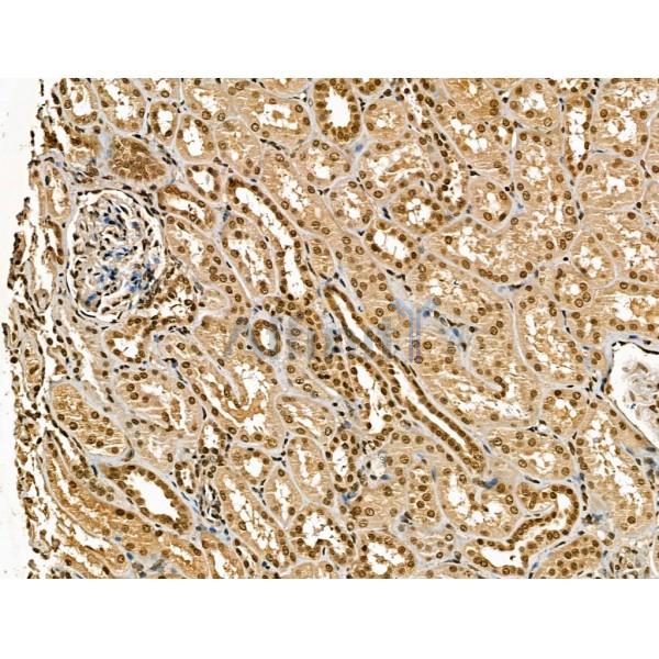 Retinoid X Receptor beta Antibody - DF13265 at 1/100 staining Human kidney cancer and adjacent normal tissues by IHC-P.