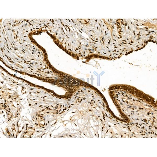 Retinoid X Receptor beta Antibody - DF13265 at 1/100 staining Human ovarian cancer and adjacent normal tissues by IHC-P.