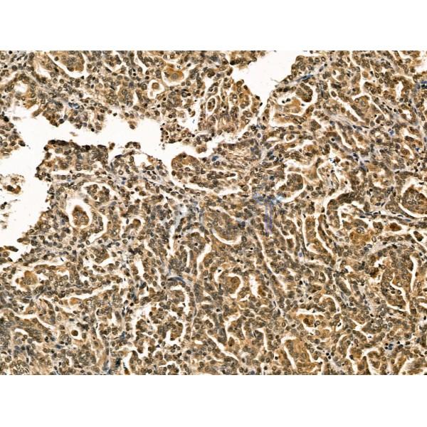 Retinoid X Receptor beta Antibody - DF13265 at 1/100 staining Human kidney cancer by IHC-P.