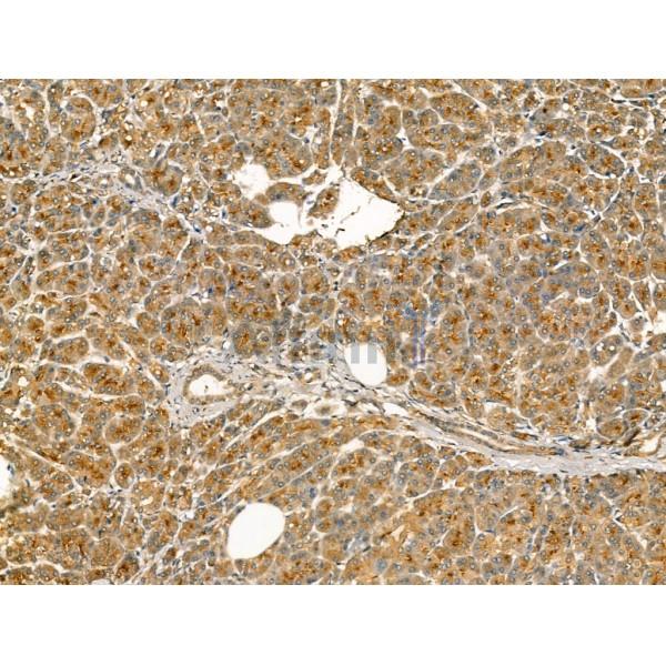 Chromogranin C Antibody - DF13266 at 1/100 staining Human pancreatic cancer and adjacent nomal tissues by IHC-P.