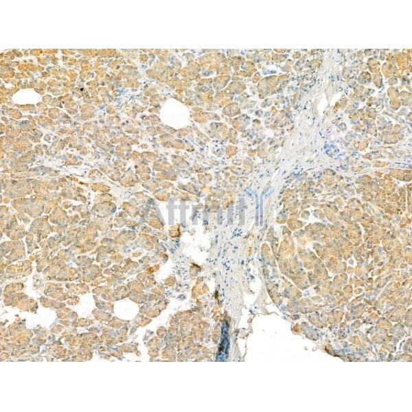Rab4 Antibody - DF13290 at 1/100 staining Human pancreatic cancer and adjacent nomal tissues by IHC-P.