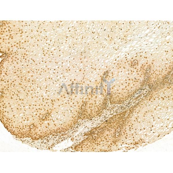 SCXA Antibody - DF13293 at 1/100 staining Human esophageal cancer and adjacent normal tissues by IHC-P.