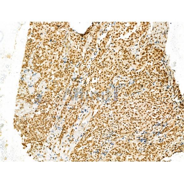 SCXA Antibody - DF13293 at 1/100 staining Human ovarian cancer by IHC-P.