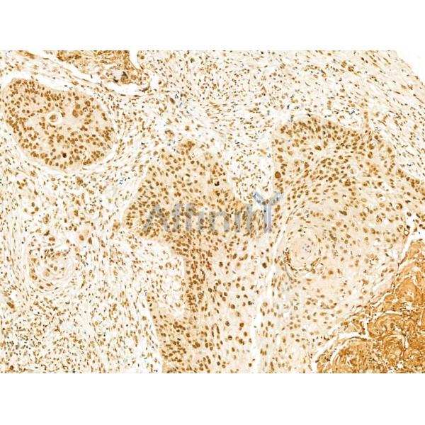 SCXA Antibody - DF13293 at 1/100 staining Human esophageal cancer by IHC-P.