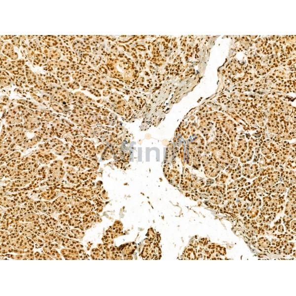 SCXA Antibody - DF13293 at 1/100 staining Human pancreatic cancer and adjacent nomal tissues by IHC-P.
