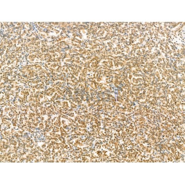 SCXA Antibody - DF13293 at 1/100 staining Human kidney cancer by IHC-P.