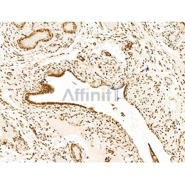 SCXA Antibody - DF13293 at 1/100 staining Human ovarian cancer and adjacent normal tissues by IHC-P.