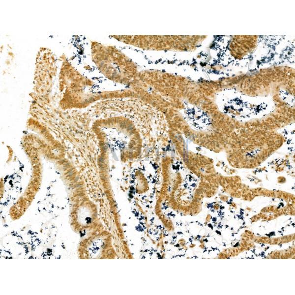 SCXA Antibody - DF13293 at 1/100 staining Human colorectal cancer by IHC-P.