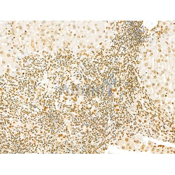 SCXA Antibody - DF13293 at 1/100 staining Human mammary cancer by IHC-P.