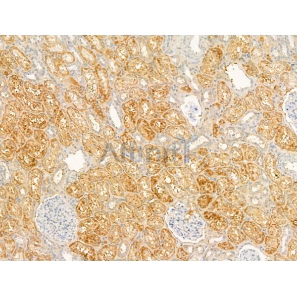 CD62P Antibody - DF13294 at 1/100 staining Human kidney cancer and adjacent normal tissues by IHC-P.