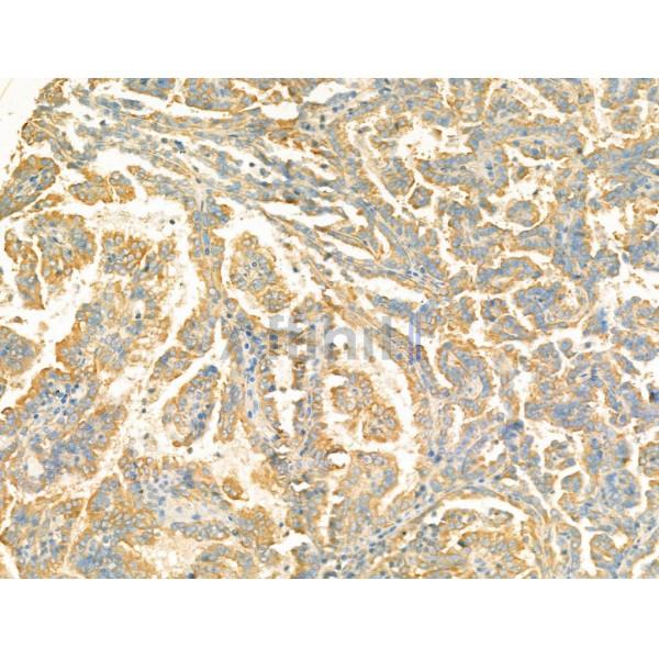 VGLUT2 Antibody - DF13296 at 1/100 staining Human kidney cancer by IHC-P.