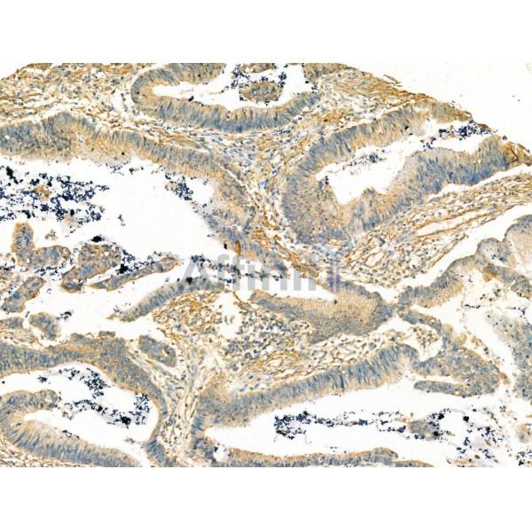 VGLUT2 Antibody - DF13296 at 1/100 staining Human colorectal cancer by IHC-P.