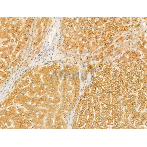 SAA2 Antibody - DF13301 at 1/100 staining Human liver cancer by IHC-P.