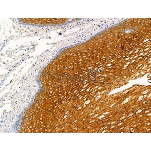 Kallikrein 9 Antibody - DF13306 at 1/100 staining Human esophageal cancer and adjacent normal tissues by IHC-P.