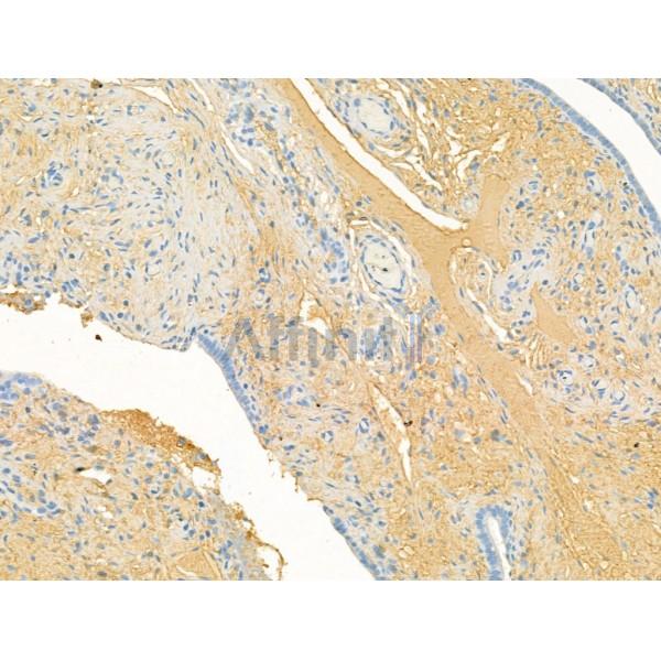 CHL1 Antibody - DF13313 at 1/100 staining Human ovarian cancer and adjacent normal tissues by IHC-P.