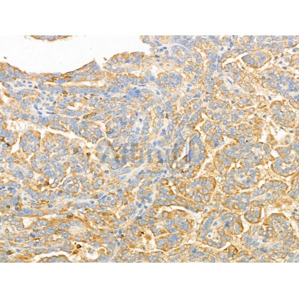 Syntaxin 2 Antibody - DF13316 at 1/100 staining Human kidney cancer by IHC-P.