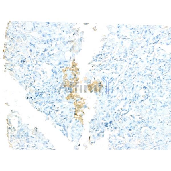 STIL Antibody - DF13333 at 1/100 staining Human lung cancer by IHC-P.