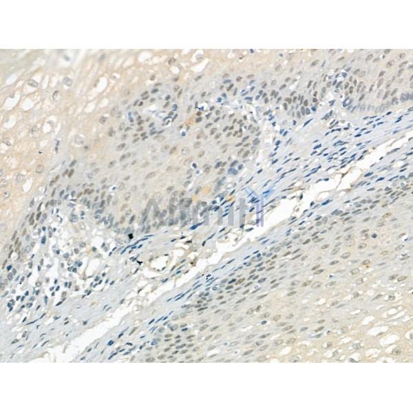 KIF17 Antibody - DF13337 at 1/100 staining Human esophageal cancer and adjacent normal tissues by IHC-P.