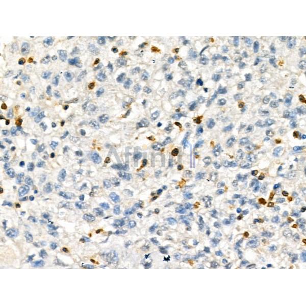 KDM4A Antibody - DF13340 at 1/100 staining Human pancreatic cancer by IHC-P.