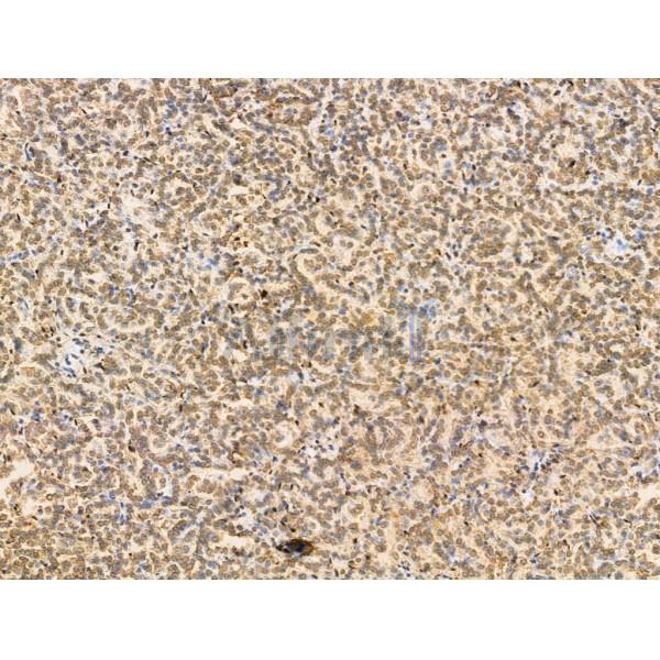 RBM3 Antibody - DF13353 at 1/100 staining Human kidney cancer by IHC-P.