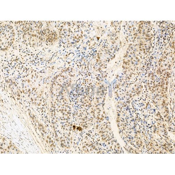 RBM3 Antibody - DF13353 at 1/100 staining Human pancreatic cancer by IHC-P.