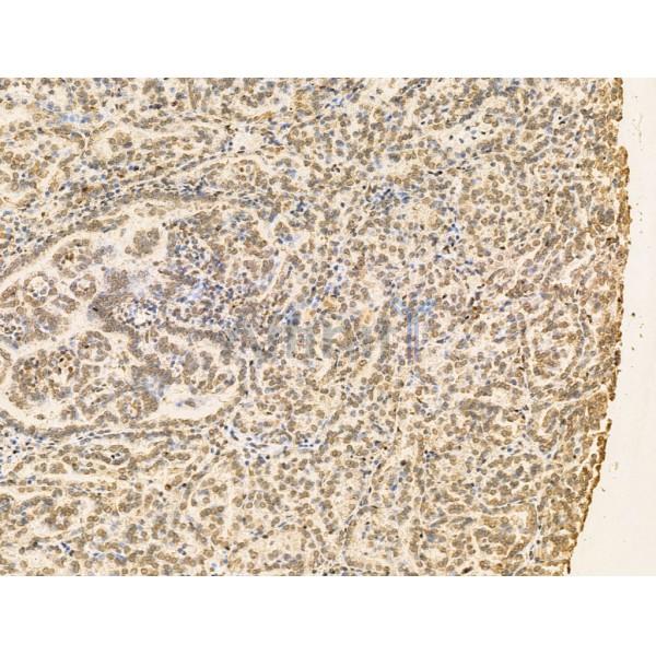RBM3 Antibody - DF13353 at 1/100 staining Human kidney cancer by IHC-P.