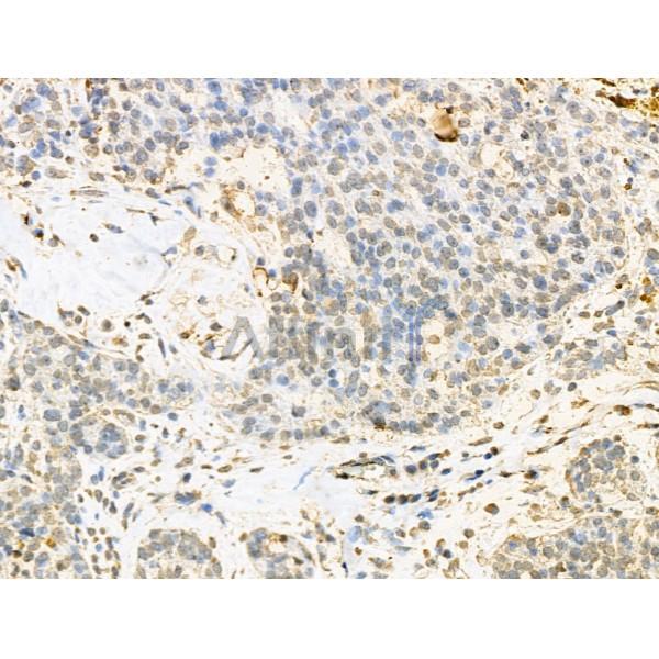 RBM3 Antibody - DF13353 at 1/100 staining Human ovarian cancer by IHC-P.