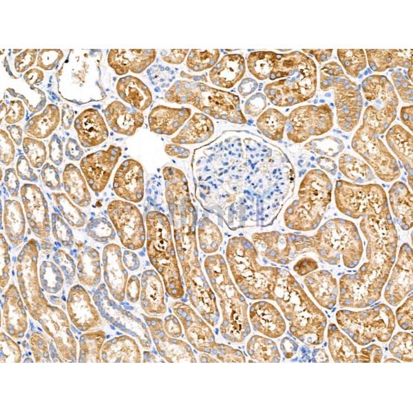 Dermcidin Antibody - DF13367 at 1/100 staining Human kidney cancer and adjacent normal tissues by IHC-P.